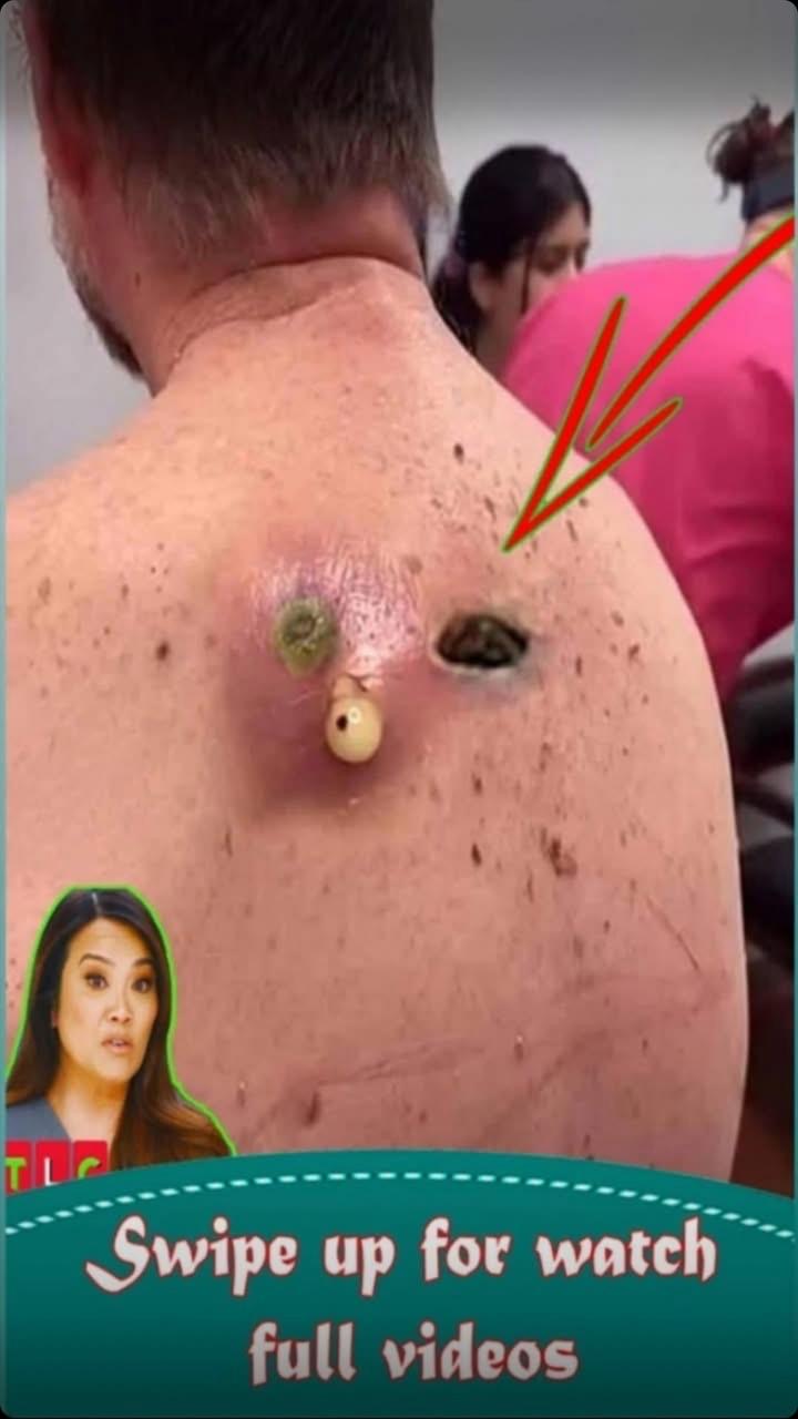 Removing blackheads can be a bit of a challenge